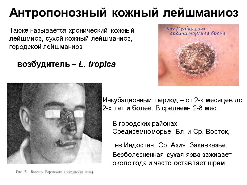 Также называется хронический кожный лейшмиоз, сухой кожный лейшманиоз, городской лейшманиоз В городских районах Средиземноморье,